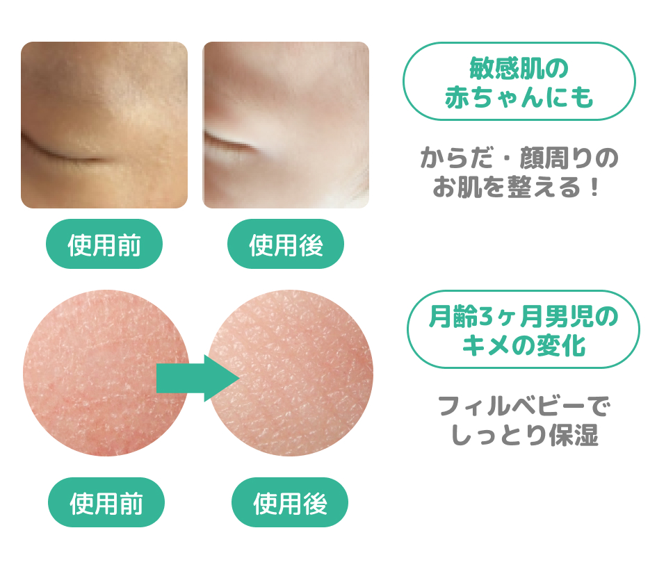 敏感肌の赤ちゃんにも:からだ・顔周りのお肌を整える!, 月齢3ヶ月男児のキメの変化:フィルベビーでしっとり保湿